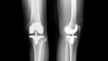 左人工膝関節置換術後、右大腿骨頸部骨折術後の症例